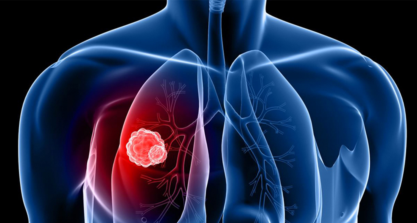 Take radon testing seriously this November for Lung Cancer Awareness